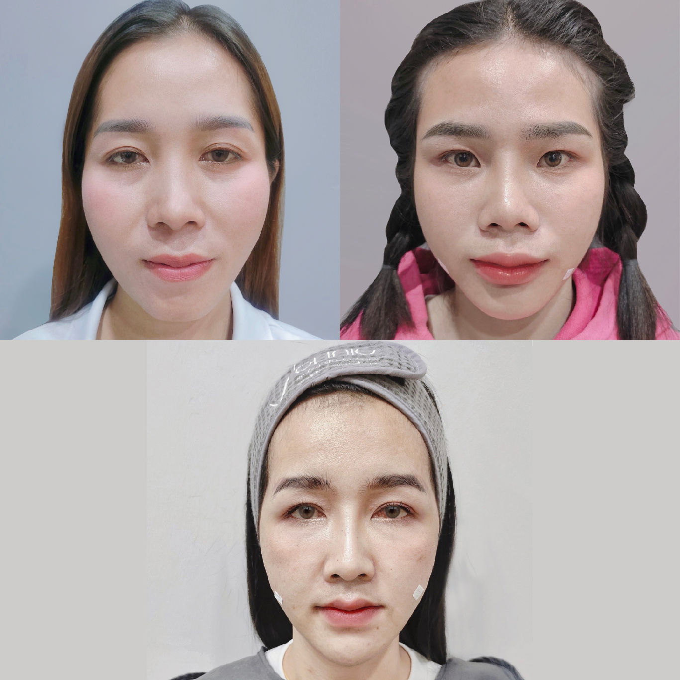 รวมรีวิวเติมฟิลเลอร์แก้มตอบ